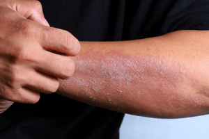 Skin problem treatment for acne, eczema, and skin disorders